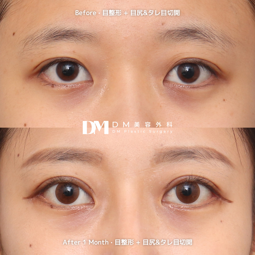/images/JPN/Eyes_EyesSurgery/EyesSurgeryBA_02.jpg